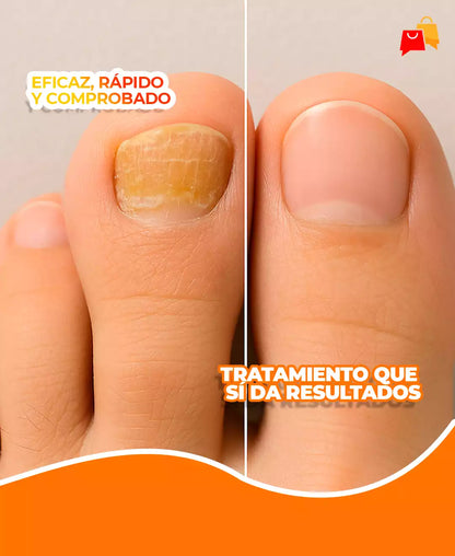 FungiClear X3